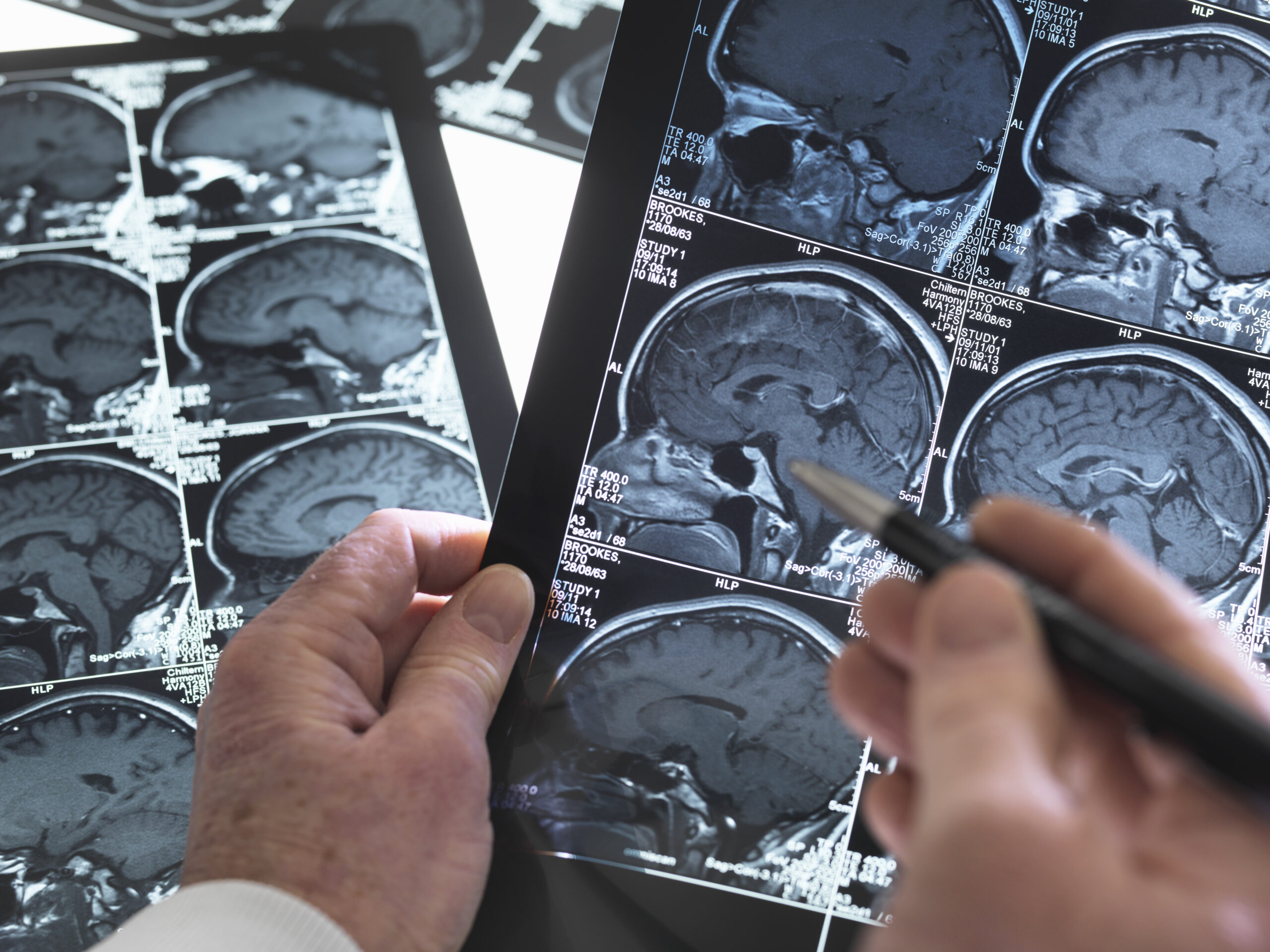 close up of doctor viewing a healthy brain scan 2025 04 03 15 38 52 utc scaled